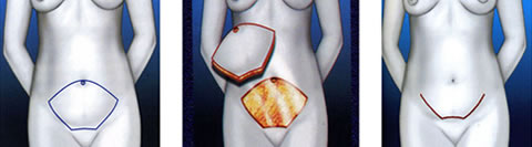 cirugia-abdominoplastia-1