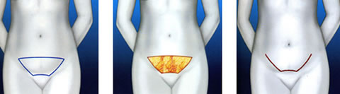cirugia-mini-abdominoplastia