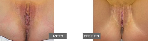cirugia-intima-vaginoplastia-labioplastia
