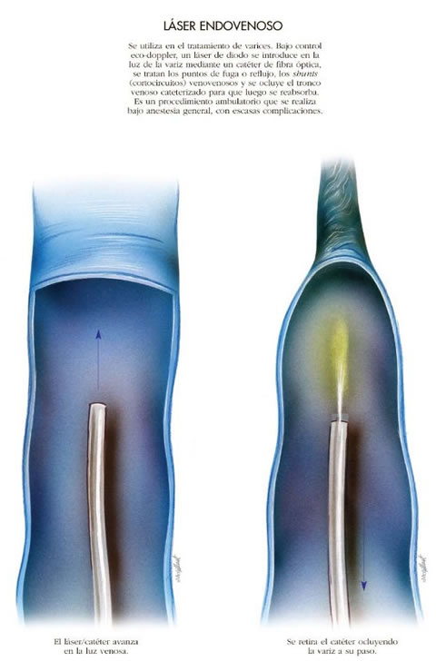 laser-varices-endovascular