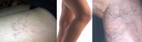 varices-piernas