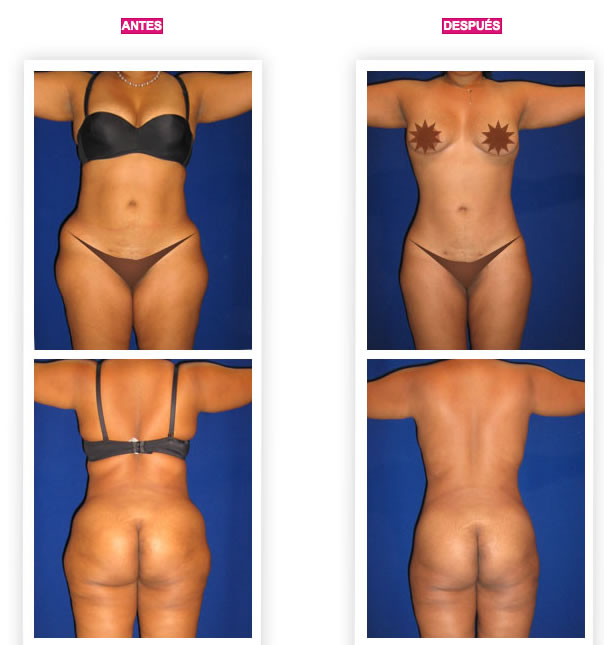 antes-y-despues-liposuccion-laser