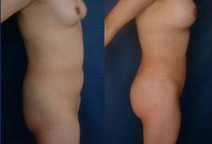 lipoescultura