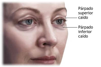 operacion-parpados-blefaroplastia