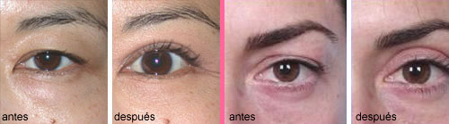 operacion-parpados-ojos