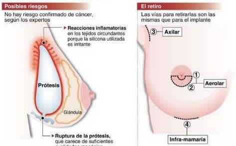 rotuta protesis PIP