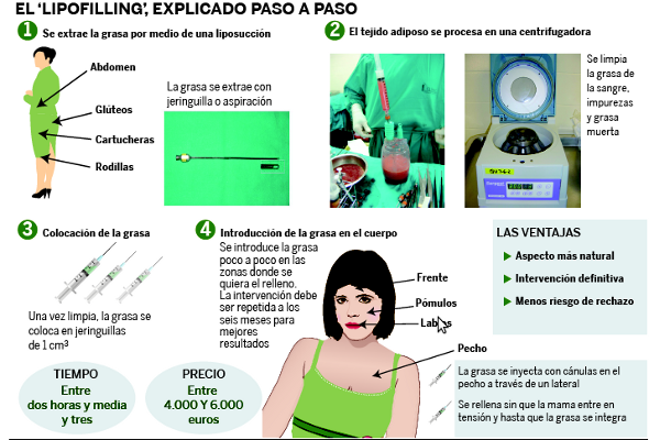lipofilling